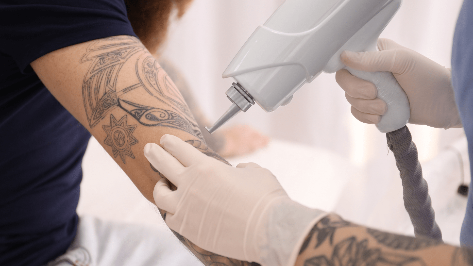 Tout ce qu'il faut savoir sur le détatouage  